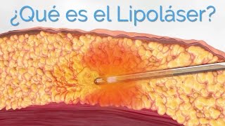Liposucción Láser ¿Qué es el Lipoláser y Para Qué Sirve