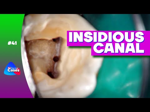Insidious Canal - Root Canal Treatment