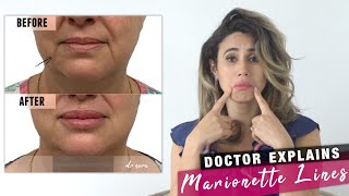 Mouth Wrinkles? How to Treat Marionette Lines | Doctor Explains