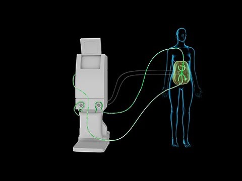 Warm intraperitoneal chemotherapy (HIPEC)