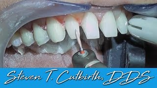 Prepping Teeth for Veneers (In-Depth Instructions) - Dental Minute with Steven T. Cutbirth, DDS