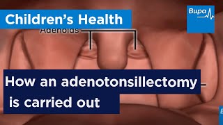 How an adenotonsillectomy is carried out