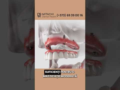 Dinți ficsi pe 4 sau 6 implanturi?
