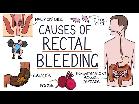 Understanding the Causes of Blood in Stool (Rectal Bleeding)