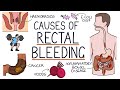 Understanding The Causes Of Blood In Stool Rectal Bleeding