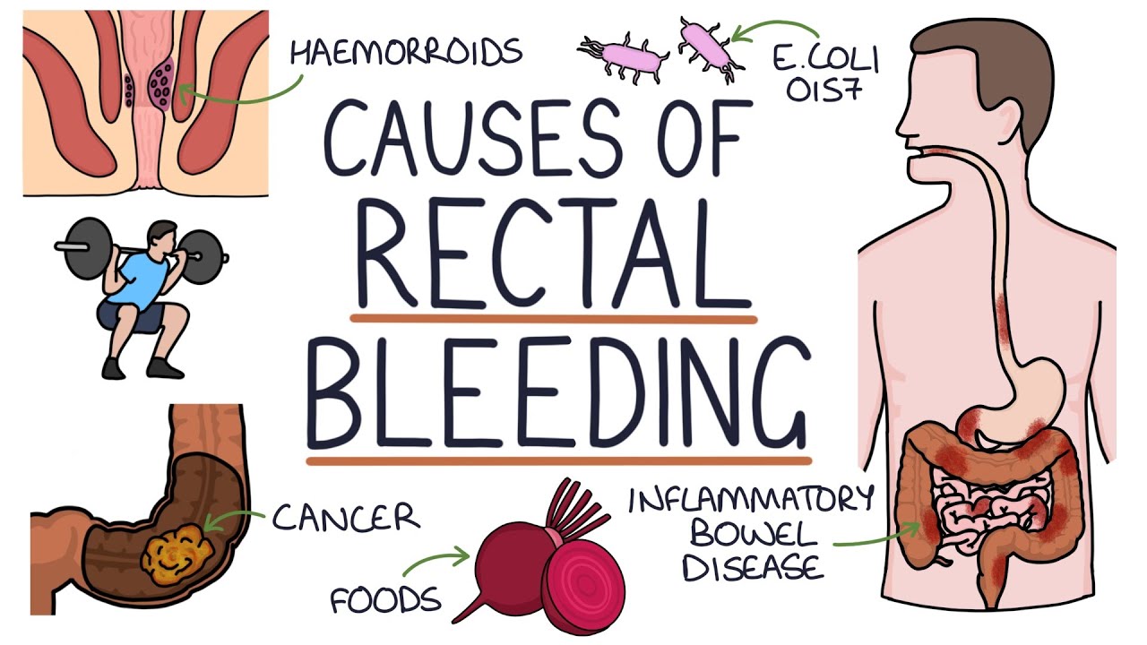 Understanding the Causes of Blood in Stool (Rectal Bleeding)