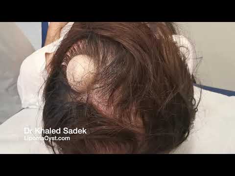 Pilar Cyst or Epidermoid? Dr Khaled Sadek. LipomaCyst.com