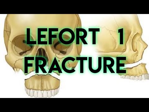 LEFORT 1  FRACTURE