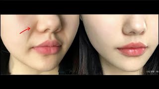 FIX SMILE LINES OVERNIGHT! lifted midface + nasolabial fold remover 