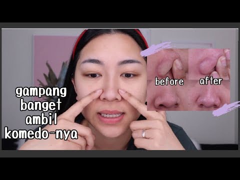 download lagu mp3 mp4 Cara Menghilangkan Komedo Sampai Akar Akarnya, download lagu Cara Menghilangkan Komedo Sampai Akar Akarnya gratis, unduh video klip Cara Menghilangkan Komedo Sampai Akar Akarnya