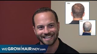 Hairline and Crown Hair Transplant Results with One Procedure