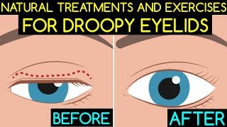 Natural Treatments and Exercises For Droopy Eyelids