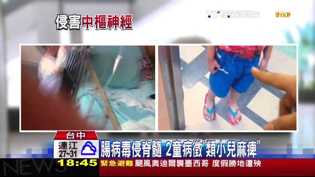 腸病毒侵脊髓 2童病徵「類小兒麻痺」