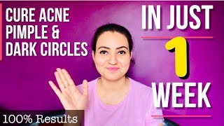 Acne Treatment : All You Need To Know About Acne And Pimple | Best Home Remedy for Acne & Pimple 💕💕
