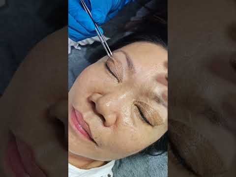 Eyelid Lifting Treatment