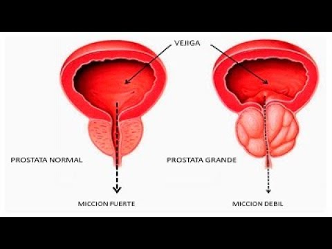 Grave BPH Buona medicina per forum prostatite cronica