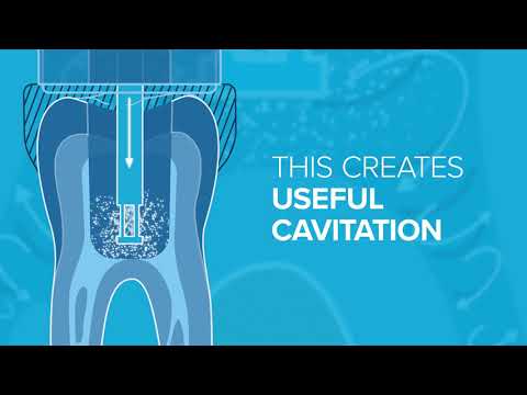 SoundBAR® Powerful Cleaning | The GentleWave® System