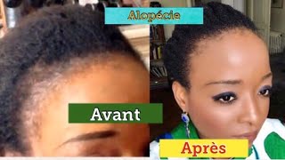 TOP 5 HUILES ESSENTIELLES CONTRE LA CHUTE DE CHEVEUX