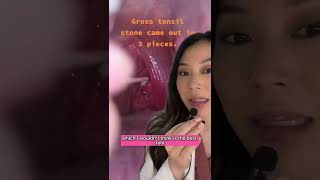 Download lagu SKILLFULLY removing huge juicy Tonsil Stones with a Sharp wooden pick! #tonsilstones mp3 Download lagu SKILLFULLY removing huge juicy Tonsil Stones with a Sharp wooden pick! #tonsilstones mp3