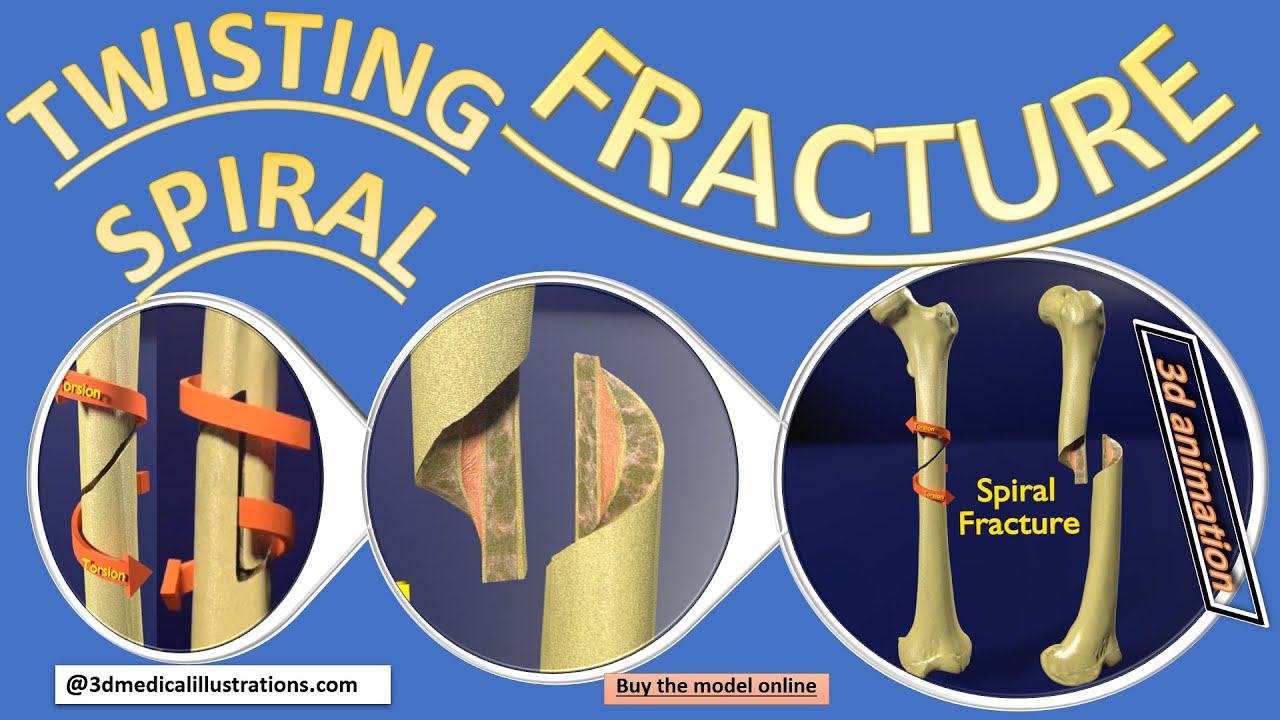 Spiral Fracture skeleton labelled femur 3D Model