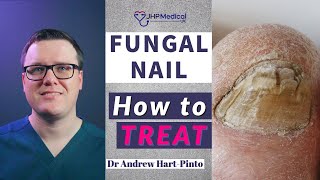 How to TREAT Fungal Nail | Get Rid Of Nail Fungus |Anti-Fungal Lacquer & Tablets