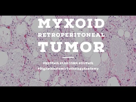 Retroperitoneal Myxoid Tumor- Well Differentiated Liposarcoma