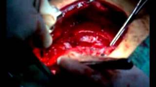 preview picture of video 'Teratoma mediastinum surgery 4_3gp'