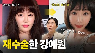 강예원 망한 앞트임… 복원하니 이렇게 달라졌다고?”