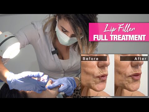 Lip Filler Treatment to Restore Lost Structure | Before and After Vlog 💋