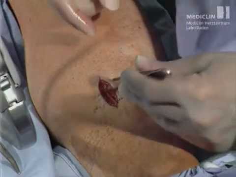 Extraction of the V. Saphena Magna in Minimaly Invasive Technique