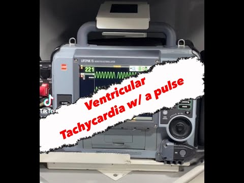 Ventricular Tachycardia w/ Pulse || Cardiac Rhythms || Paramedic/EMS Cardiology