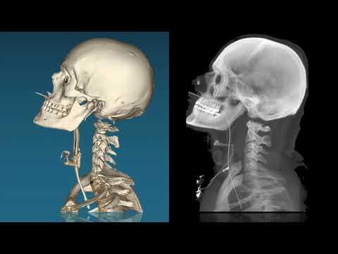 cervical spine trauma
