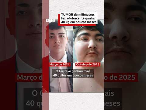 Tumor com menos de 1 centímetro fez adolescente ganhar 40 quilos em 6 meses