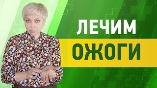 Чем намазать ожог дома, если ничего нет - видео онлайн