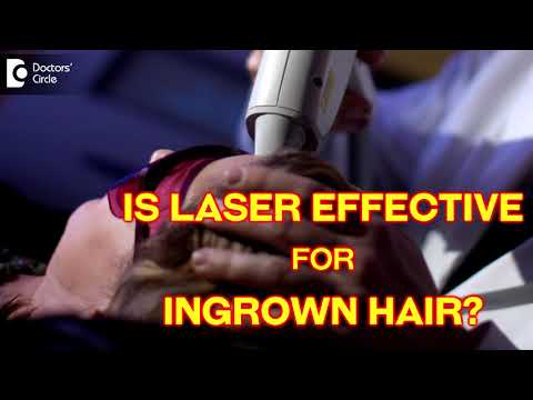 YouTube video about: Does laser hair removal get rid of strawberry legs?