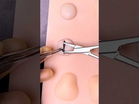 Ear Cyst Pop