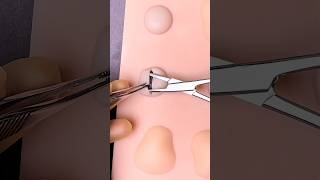 Cyst Removal Surgery 😷 #goodtoknow #vet #medicine #funfacts #surgeonlife #doctor #nurse #lifehacks