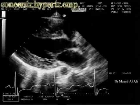 Concentric Hypertrophic Cardiomyopathy