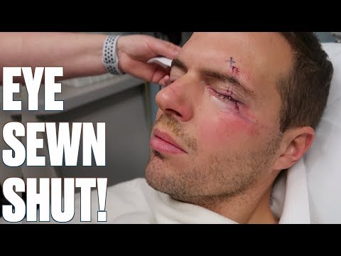 EYE SEWN SHUT AFTER SURGERY | CRAZY STITCHES AFTER SURGERY TO REMOVE MASS UNDER MY EYE Video