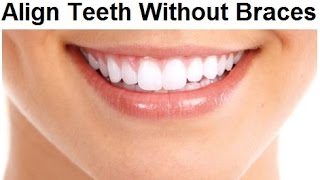 Can I Get Straight Teeth Without Braces by Prof John Mew