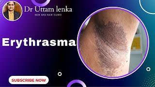 Erythrasma | Black spots in underarm , below breast, groin / बग़ल का काला दाग / Dr Uttam Kumar Lenka