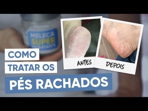 Como tratar os pés ressecados e rachados - Tua Saúde