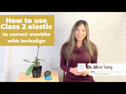 How to use Class II elastics with Invisalign?_ Dr. Yang's Invisalign Journey (8)
