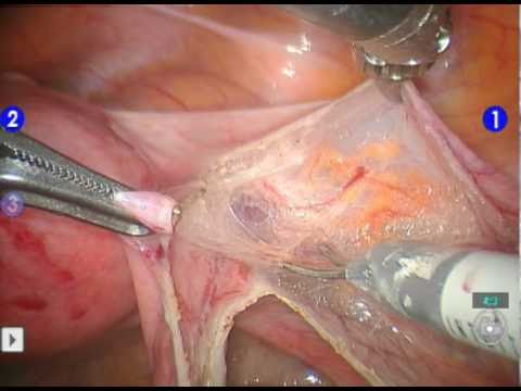 Robotic Hysterectomy in a Jehovah's Witness Patient with Endometrial Cancer