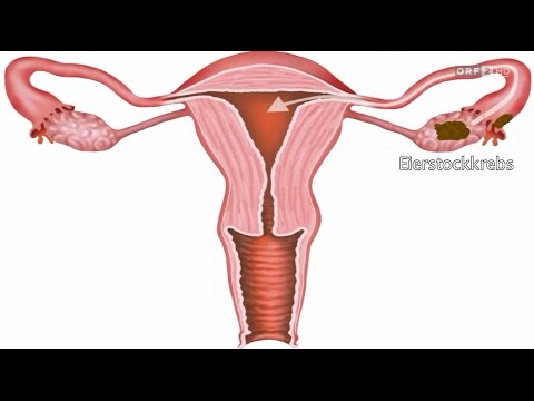 Bewusst gesund  Das Magazin 19 03 2016 Eierstockkrebs Früherkennung 720p HDTV