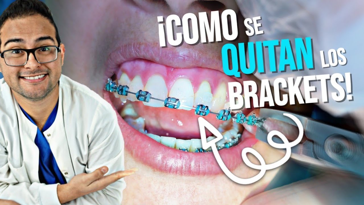COMO se QUITAN los BRACKETS 👄 y se PONEN los RETENEDORES 🔥 RETIRO de ORTODONCIA - BRACES OFF 2019