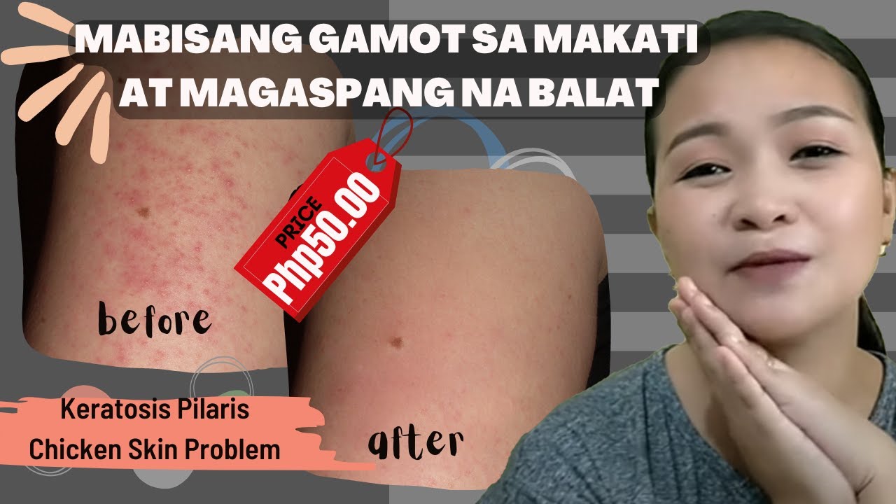 MABISANG GAMOT SA MAKATI AT MAGASPANG NA BALAT