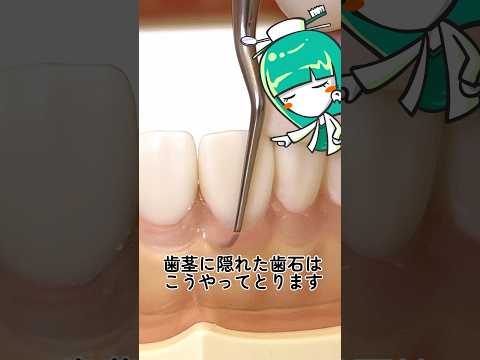 Here's how to remove tartar hidden under your gums: