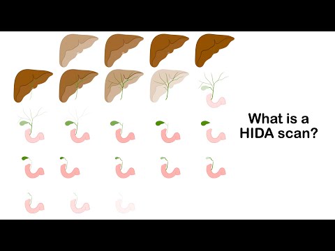 What is a HIDA scan and how is it performed?