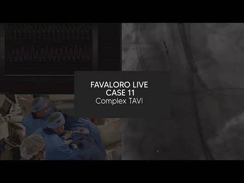 Favaloro Live Case N ° 11 - Complex TAVI